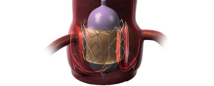 Транскатетерная замена аортального клапана